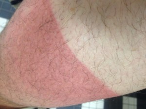 dave-masterson-sunburn-leg